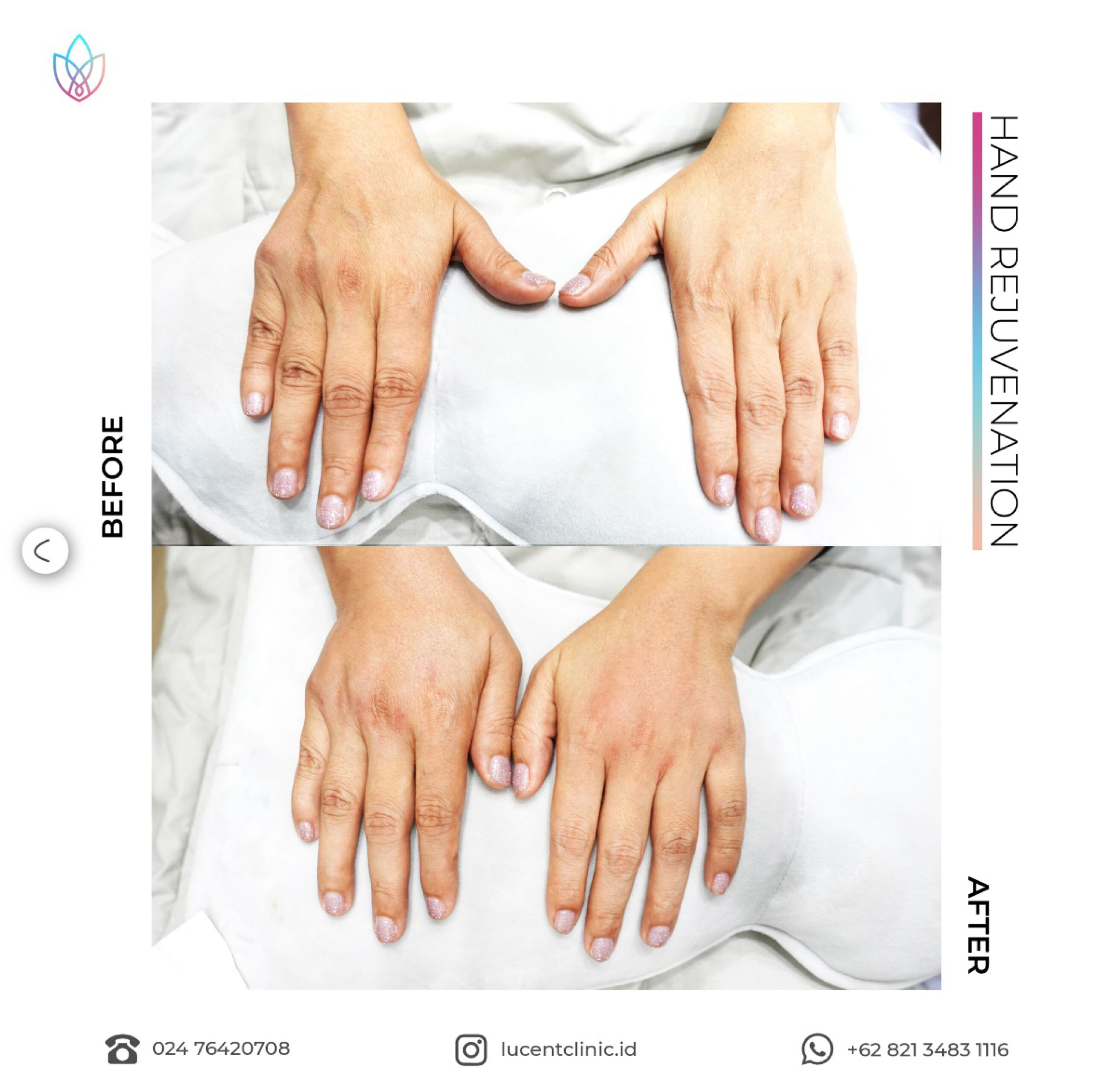 Treatment Hand Rejuvenation Terbaik di Semarang